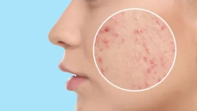 علاج حب الشباب في 5 خطوات فعّالة ونهائية في 2025