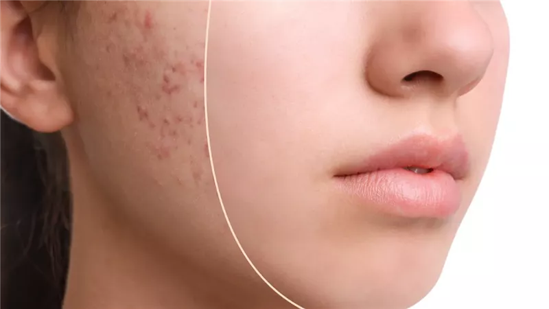 علاج حب الشباب في 5 خطوات فعّالة ونهائية في 2025